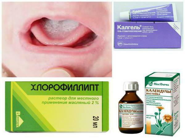 stomatitis on cheek treatment