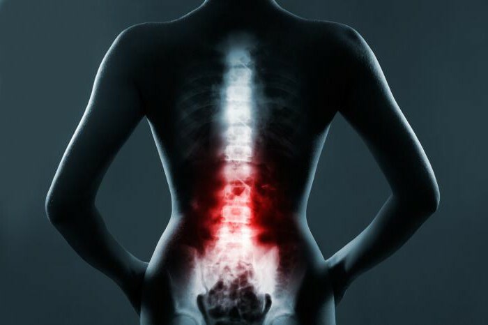 how to get rid of scoliosis
