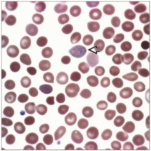 hypochromic hyperseremic sidero-hrstic sideroblastic anemia 5