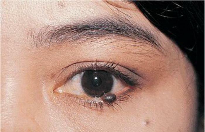 remove birthmark on eye