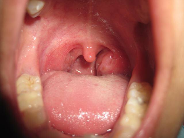 tonsillitis chronic what is it