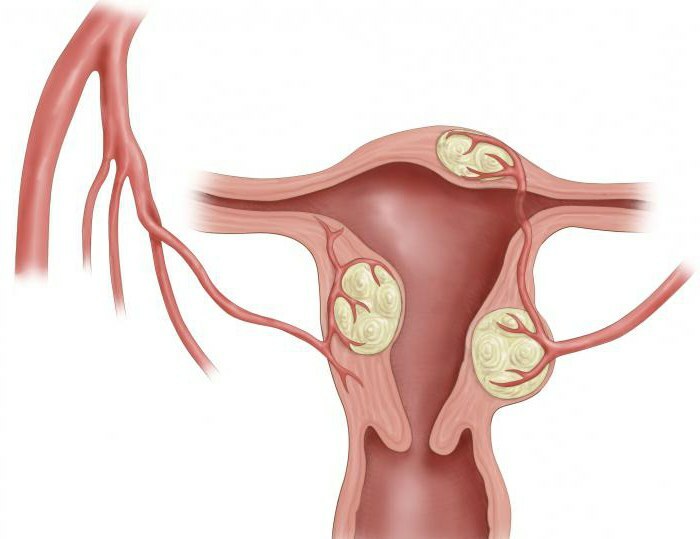 Treatment of uterine fibroids is effective folk remedies