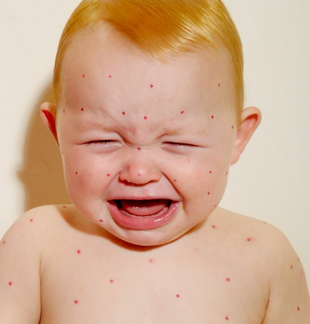 Symptoms of chicken pox in a child