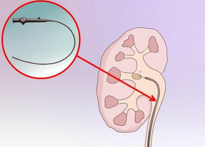 how to dissolve urate kidney stones